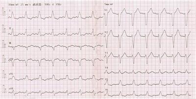 Cardiomyopathy Associated With Tertiary Adrenal Insufficiency Manifesting as Refractory Heart Failure, Shock, and Sudden Cardiac Death: A Case Report